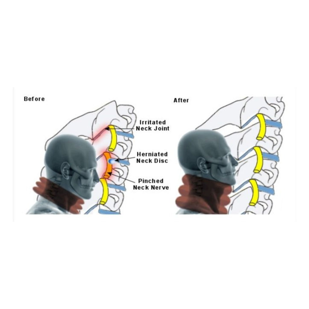 Inflatable neck collar with hand pump