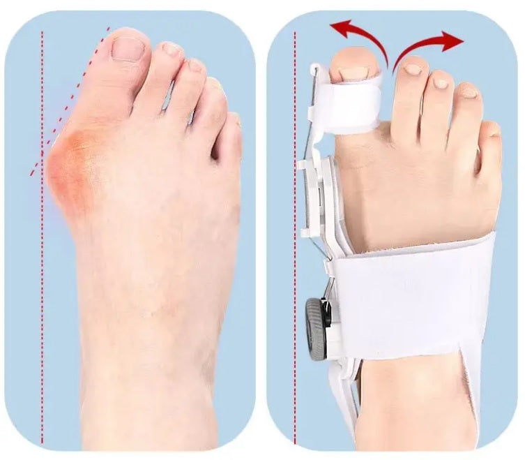 TOE SPLINT BUNION CORRECTOR