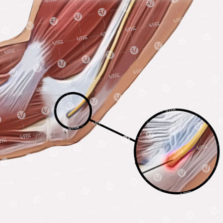 Ulnar Neuritis Splint Νάρθηκας Ωλένιας Νευρίτιδας