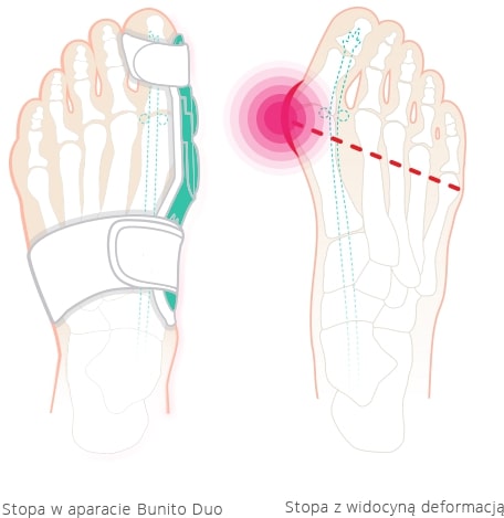 BUNITO DUO HALLUX VALGUS SPLINT