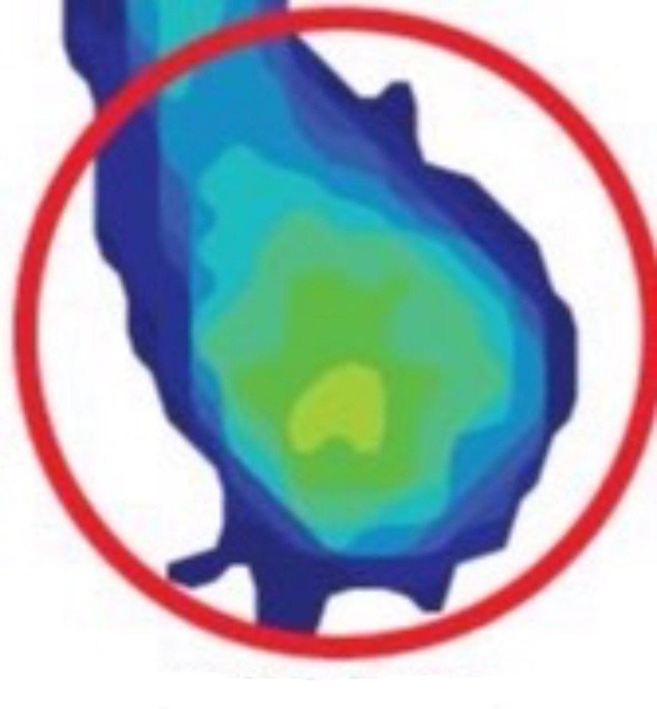 Scan with Darco Heel Wedge Shoe